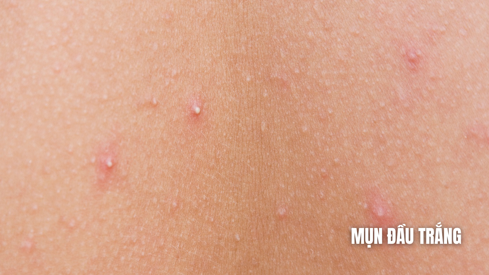 Mun-da-trang-tren-da