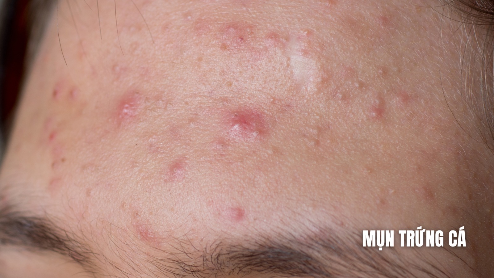 Mun-trung-ca-tren-da